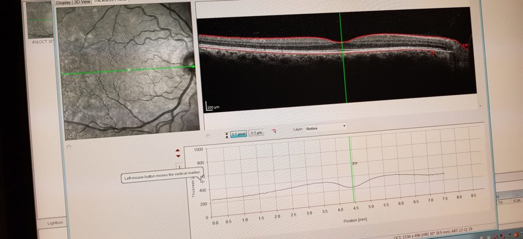 Echo scan oog